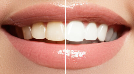 Top affordable teeth-whitening methods and products