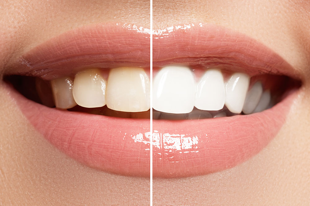 Top affordable teeth-whitening methods and products