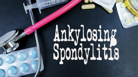 Ankylosing spondylitis &#8211; Causes, symptoms, and management