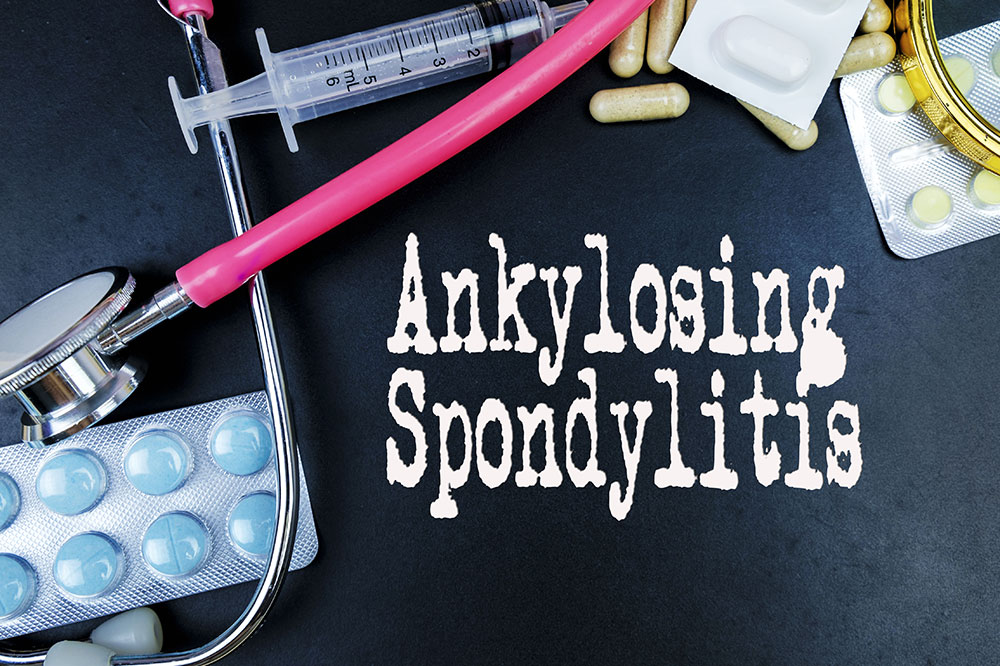 Ankylosing spondylitis &#8211; Causes, symptoms, and management