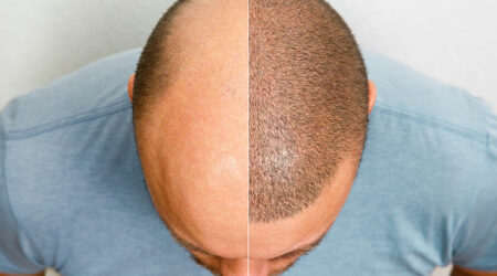 Essential things to know about hair transplantation