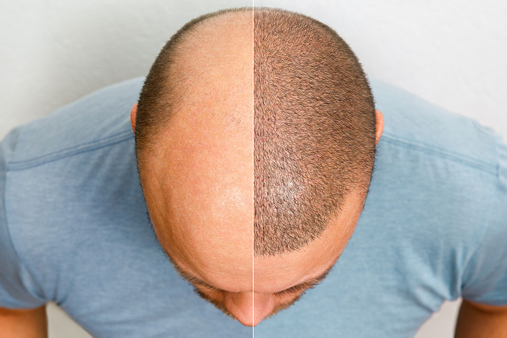 Essential things to know about hair transplantation