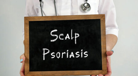 Scalp psoriasis &#8211; Signs, causes, and management