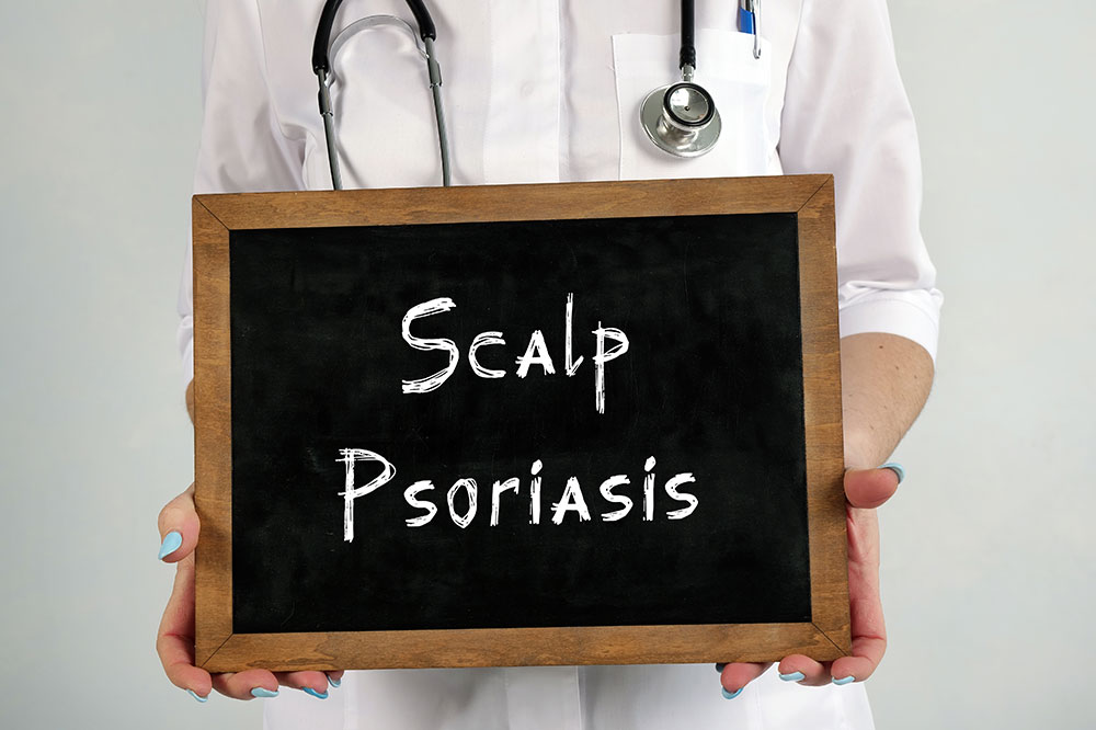 Scalp psoriasis &#8211; Signs, causes, and management