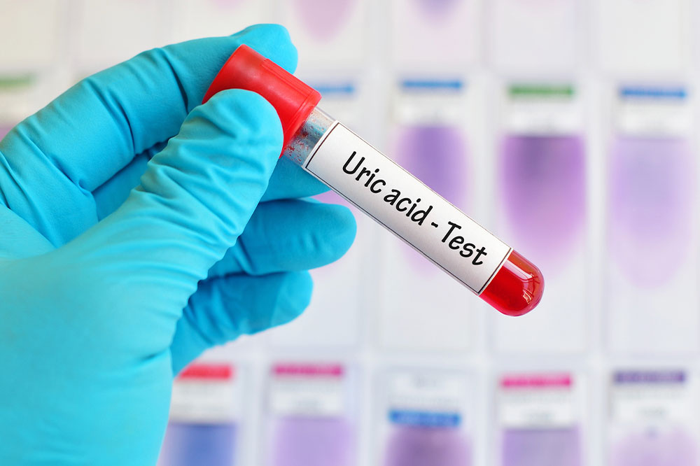 Top signs and management tips for uric acid imbalance