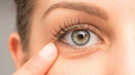 What are eye bags and how to manage them