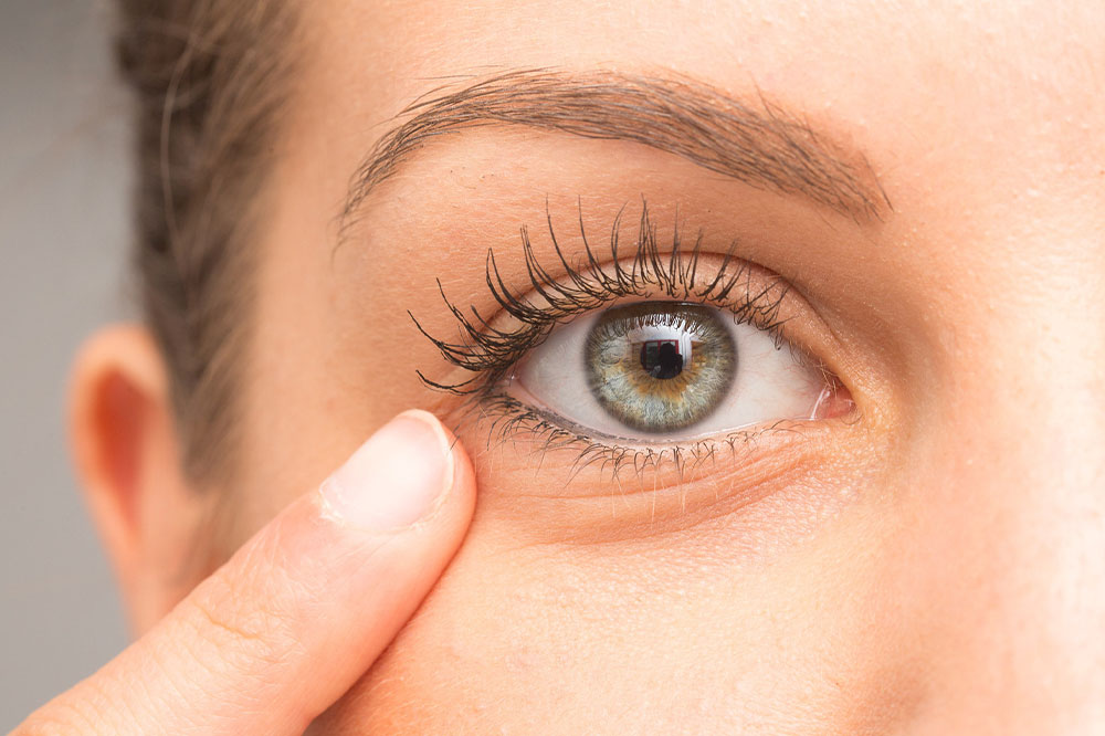 What are eye bags and how to manage them