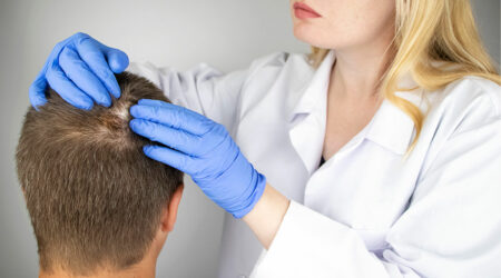 Alopecia areata &#8211; Causes, symptoms, and prognosis