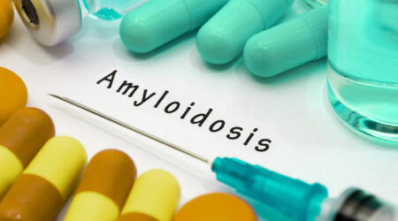 Amyloidosis &#8211; Signs, causes, and management