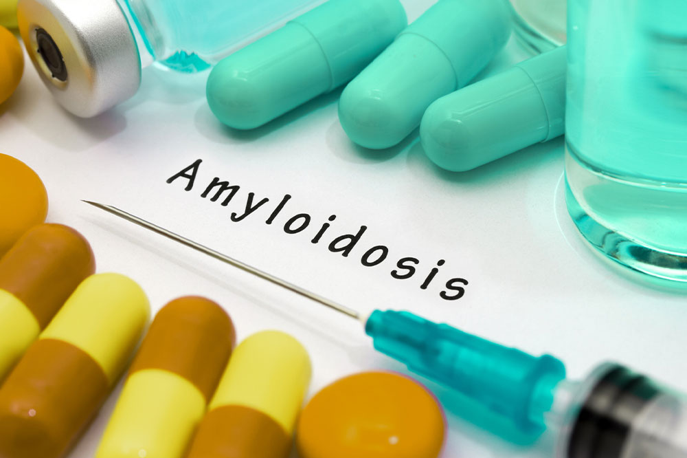 Amyloidosis &#8211; Signs, causes, and management