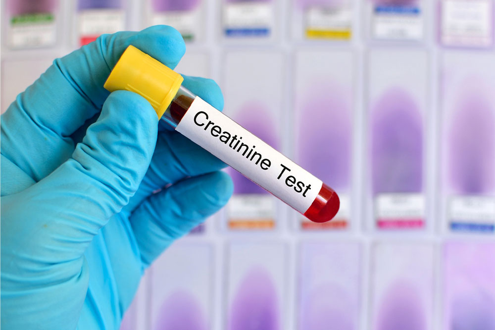 Causes, symptoms, and management of high creatinine