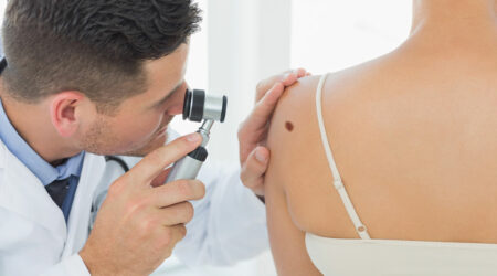 Causes, symptoms, and management options of melanoma