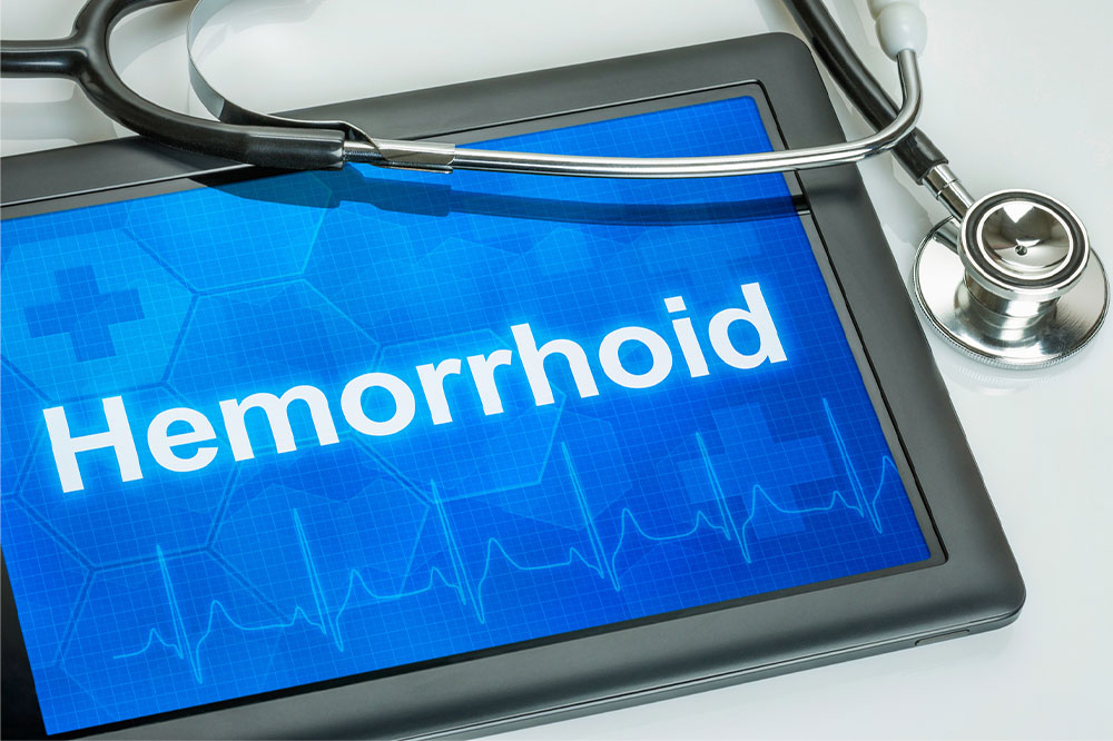 Hemorrhoids – Causes, symptoms, and management options