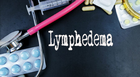 Lymphedema &#8211; Causes, signs, and management options