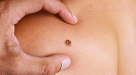 4 common types of melanoma and their treatment options