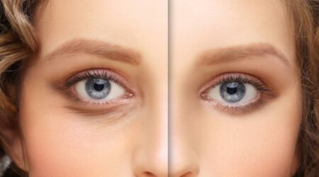 Under-eye bags &#8211; Causes, symptoms, and management