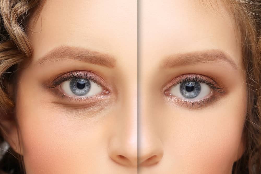 Under-eye bags &#8211; Causes, symptoms, and management