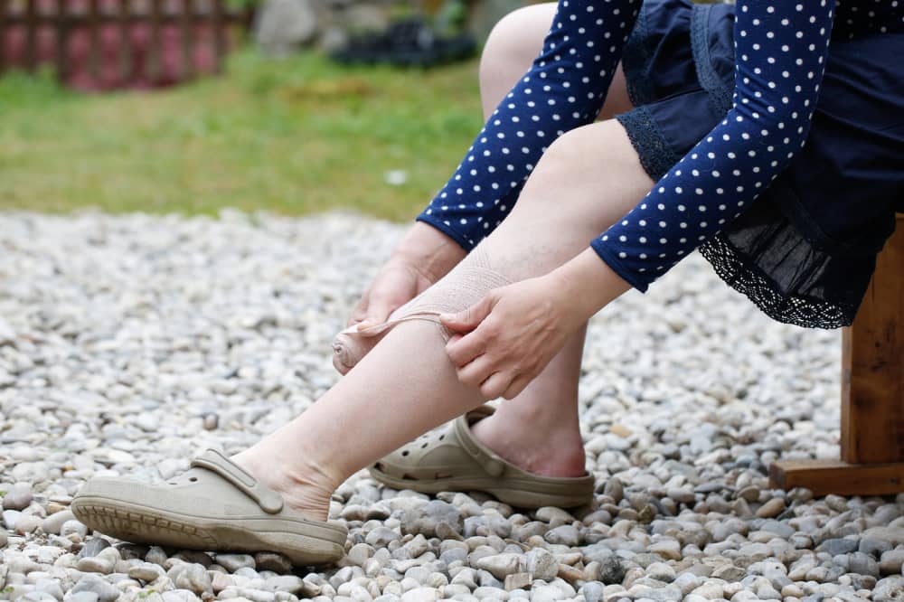 Varicose veins &#8211; Causes, symptoms, and management