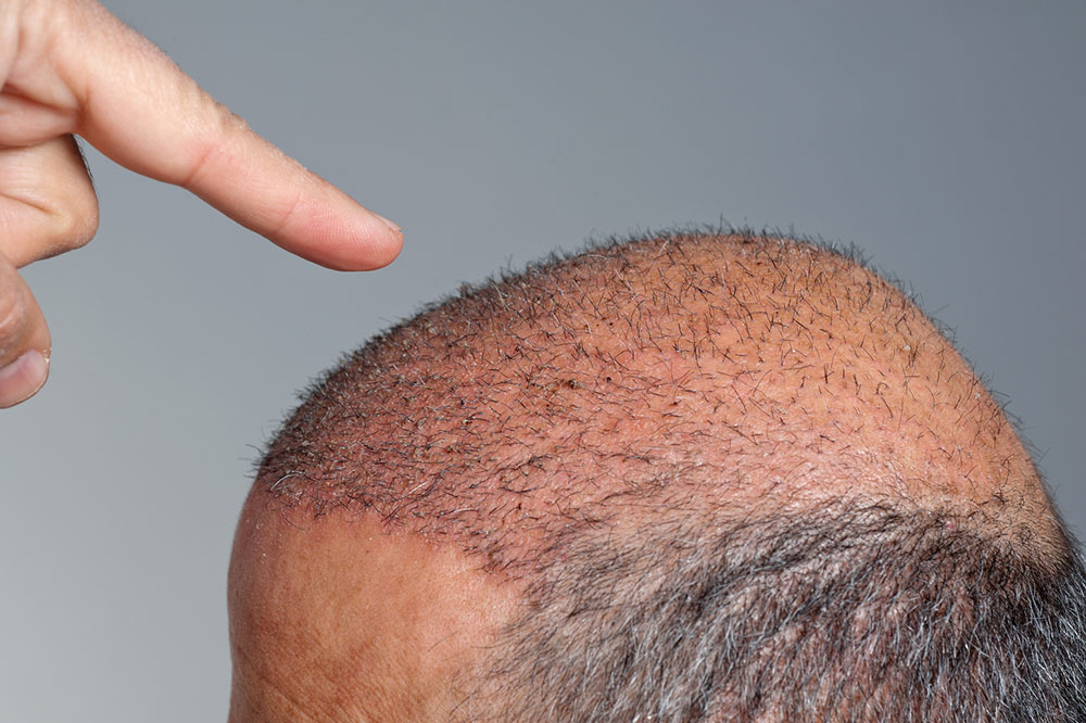 A guide to hair transplantation costs in Canada
