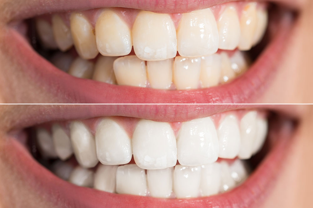 Here’s what you need to know about teeth whitening procedure