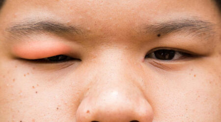 Home remedies to cure everyday eye infections