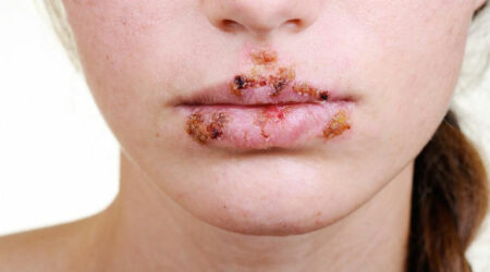 Tips to manage herpes outbreak