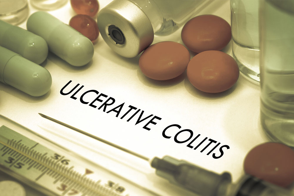 Ulcerative colitis – Symptoms, causes, and treatment