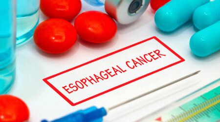 Esophageal cancer &#8211; Causes, symptoms, and management