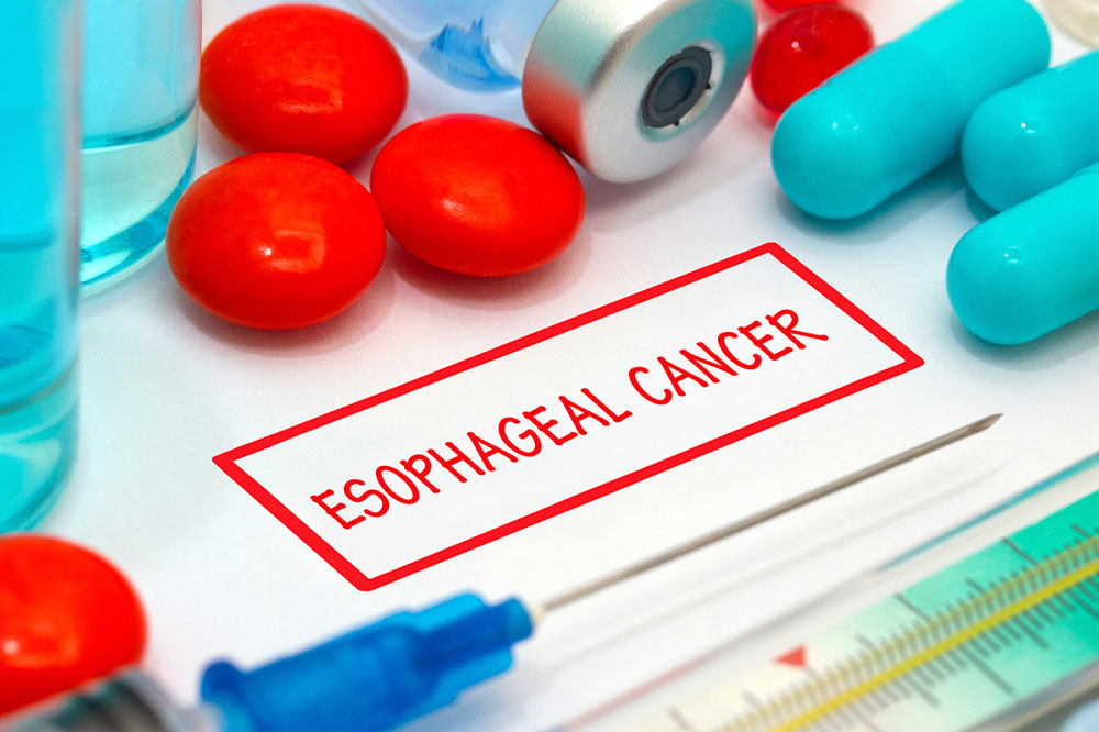 Esophageal cancer &#8211; Causes, symptoms, and management