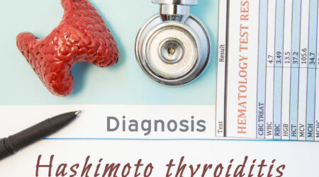 Hashimoto&#8217;s thyroiditis &#8211; Symptoms, Causes, and Management