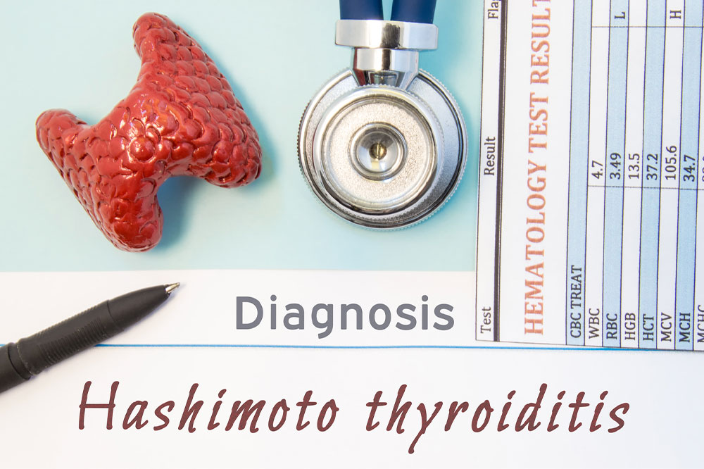 Hashimoto&#8217;s thyroiditis &#8211; Symptoms, Causes, and Management