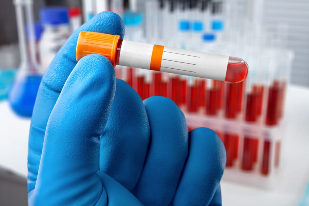 Key things to know about a hematocrit test