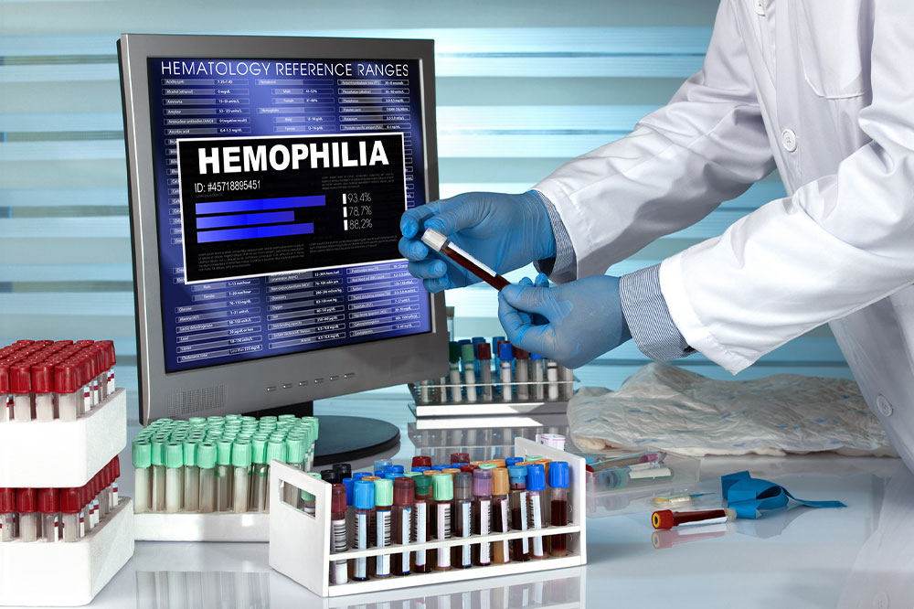 Signs, causes, and management of hemophilia