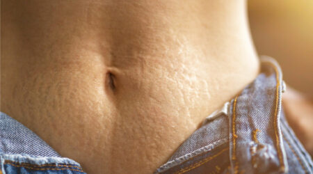 Stretch marks &#8211; Causes, remedies, and prevention